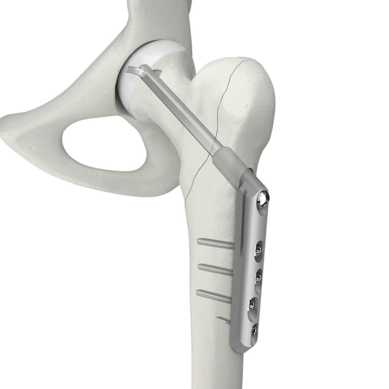 Orthopaedic implants and medical products - Swemac