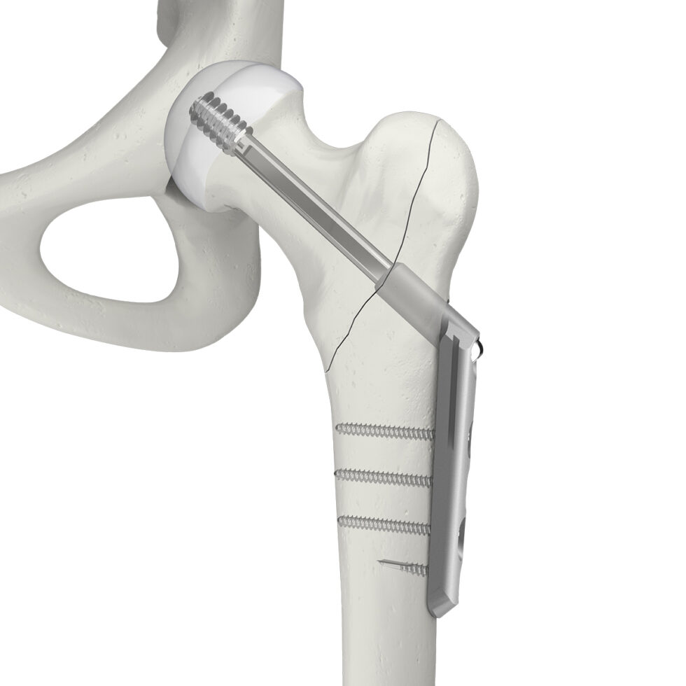 Orthopaedic implants and medical products - Swemac