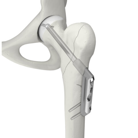 Orthopaedic implants and medical products - Swemac