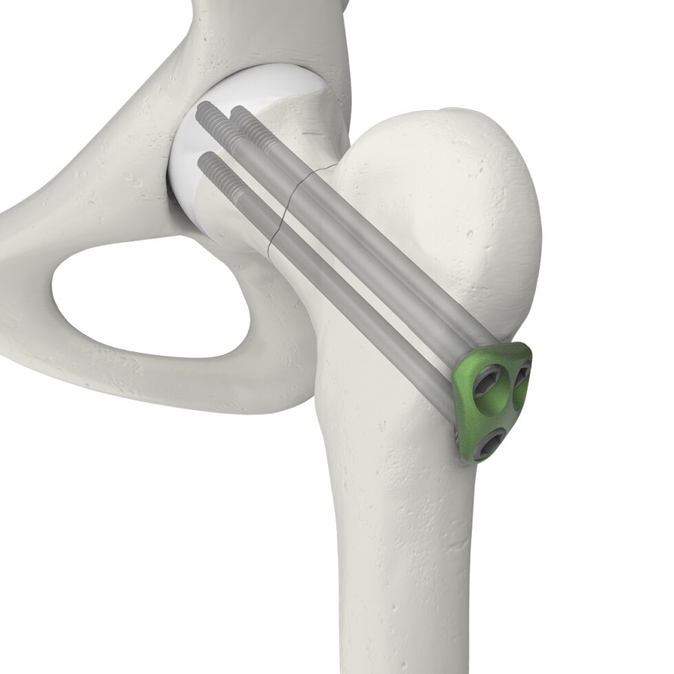 Orthopaedic implants and medical products - Swemac