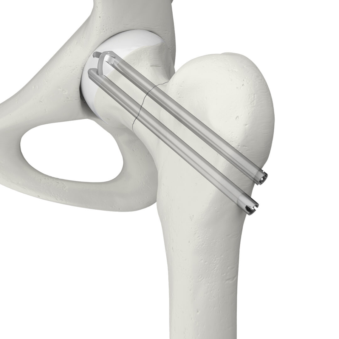 Orthopaedic implants and medical products - Swemac