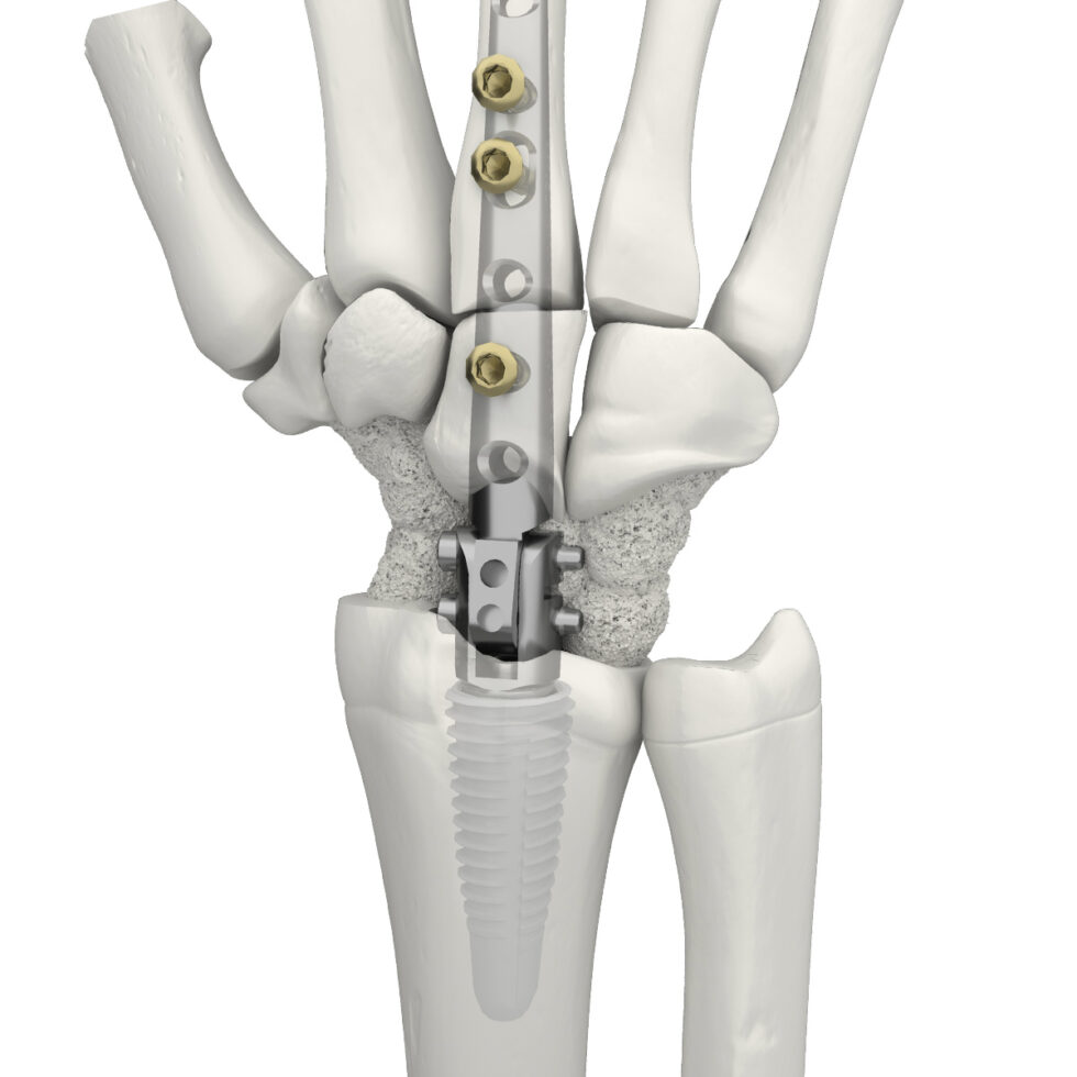 Orthopaedic implants and medical products Swemac