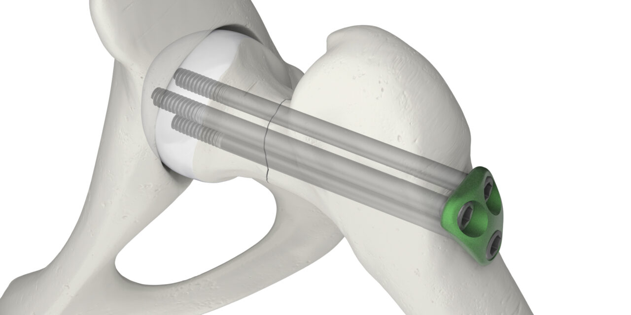 Dynaloc Solid Femoral Neck Fracture System Swemac