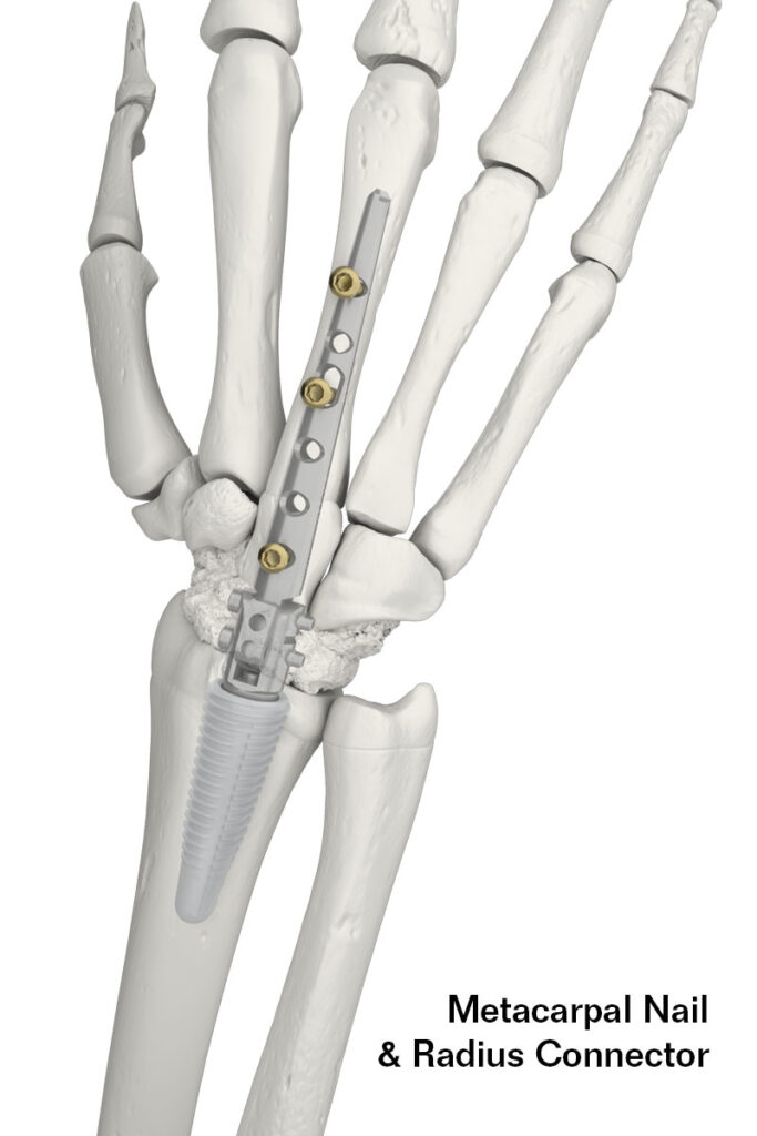 Motec Wrist Joint Arthrodesis System - Swemac